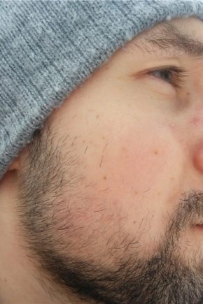Why is the beard not growing on the cheeks and how to fix it?