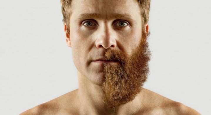 La barbe pousse de manière inégale: causes, traitement et soins