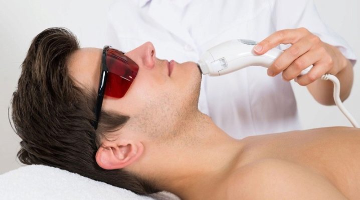 Men's laser facial hair removal