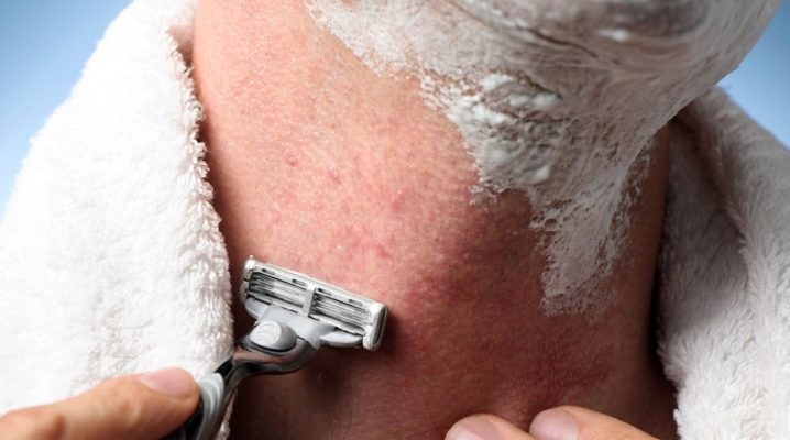Ερεθισμός ξυρίσματος: γιατί εμφανίζεται και πώς να τον ξεφορτωθείτε;